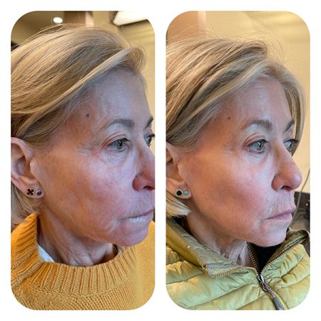 Biostimulation before and after