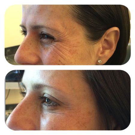 Botox Crows Feet before and after