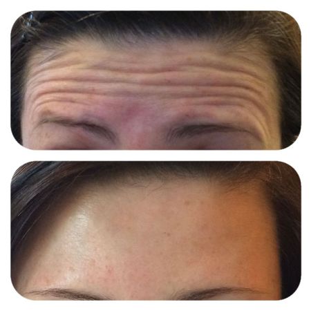 Botox Forehead before and after