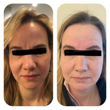 Botox Frown Line before and after