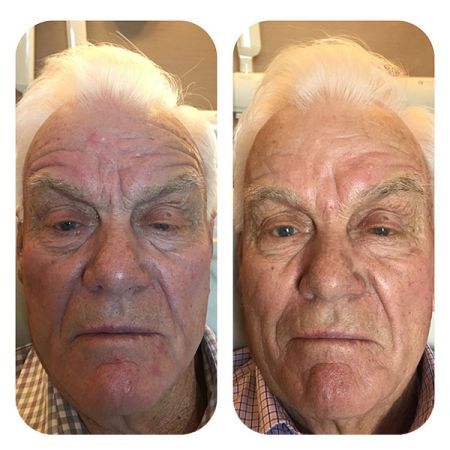 Eye Skin tightening with Radio Frequency before and after