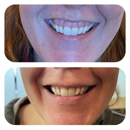 Gummy Smiles before and after