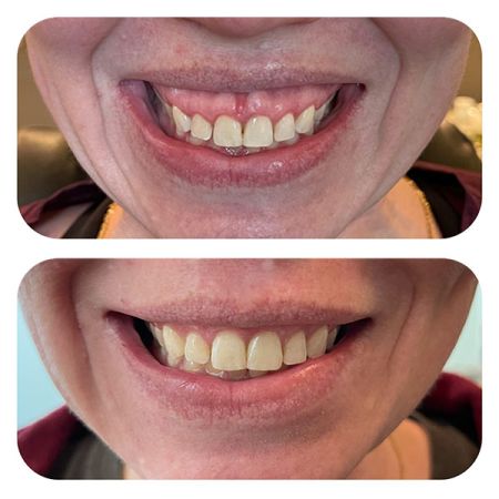 Gummy Smiles before and after