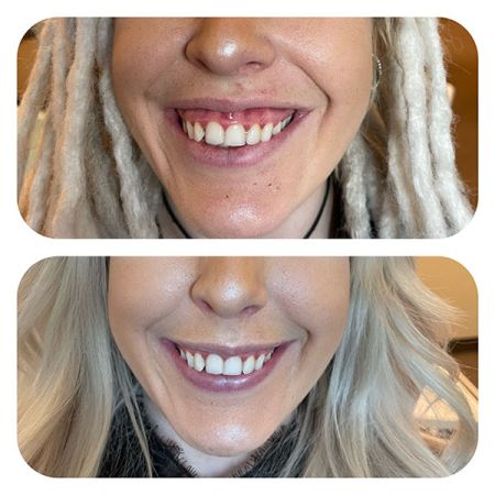Gummy Smiles before and after