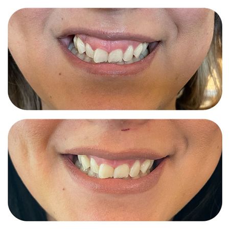 Gummy Smiles before and after