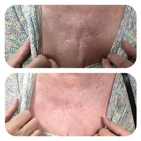 IPL Scar revision before and after