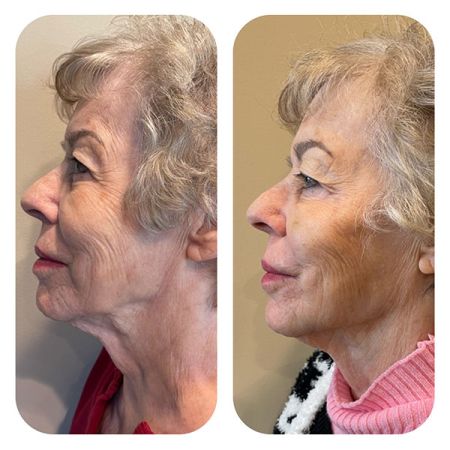 Jaw Line Filler before and after