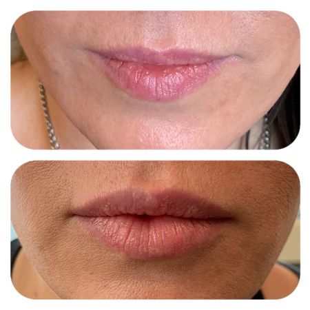 Lip Filler before and after