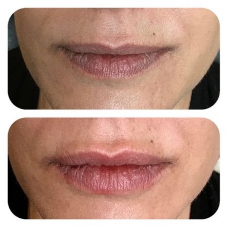 Lip Filler before and after