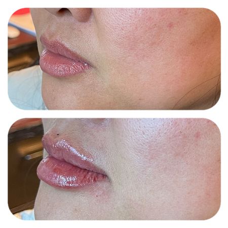 Lip Filler before and after