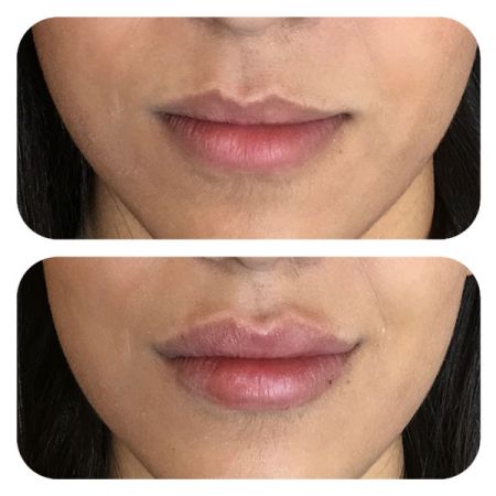 Lip Filler before and after
