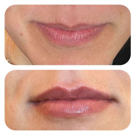 Lip Filler before and after