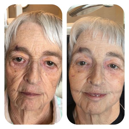 Midface Filler before and after