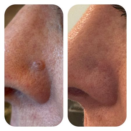 Mole Removal before and after