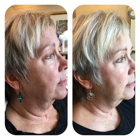 Neck Skin tighteninf with Radiofrequency before and after