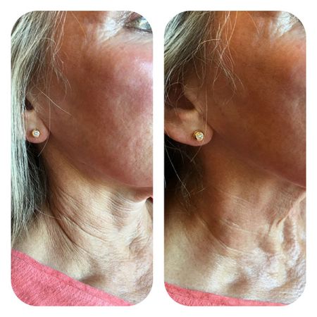 Neck Skin tighteninf with Radiofrequency before and after