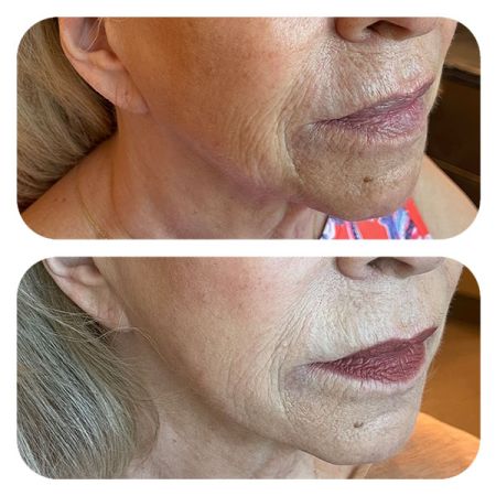 PDO Lifting Threads before and after