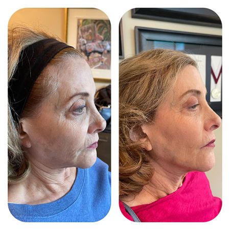 PDO Lifting Threads before and after