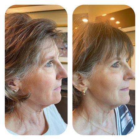 PDO Lifting Threads before and after