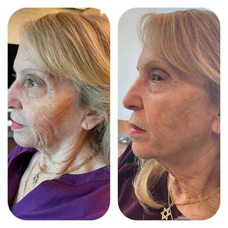 PDO Lifting Threads before and after